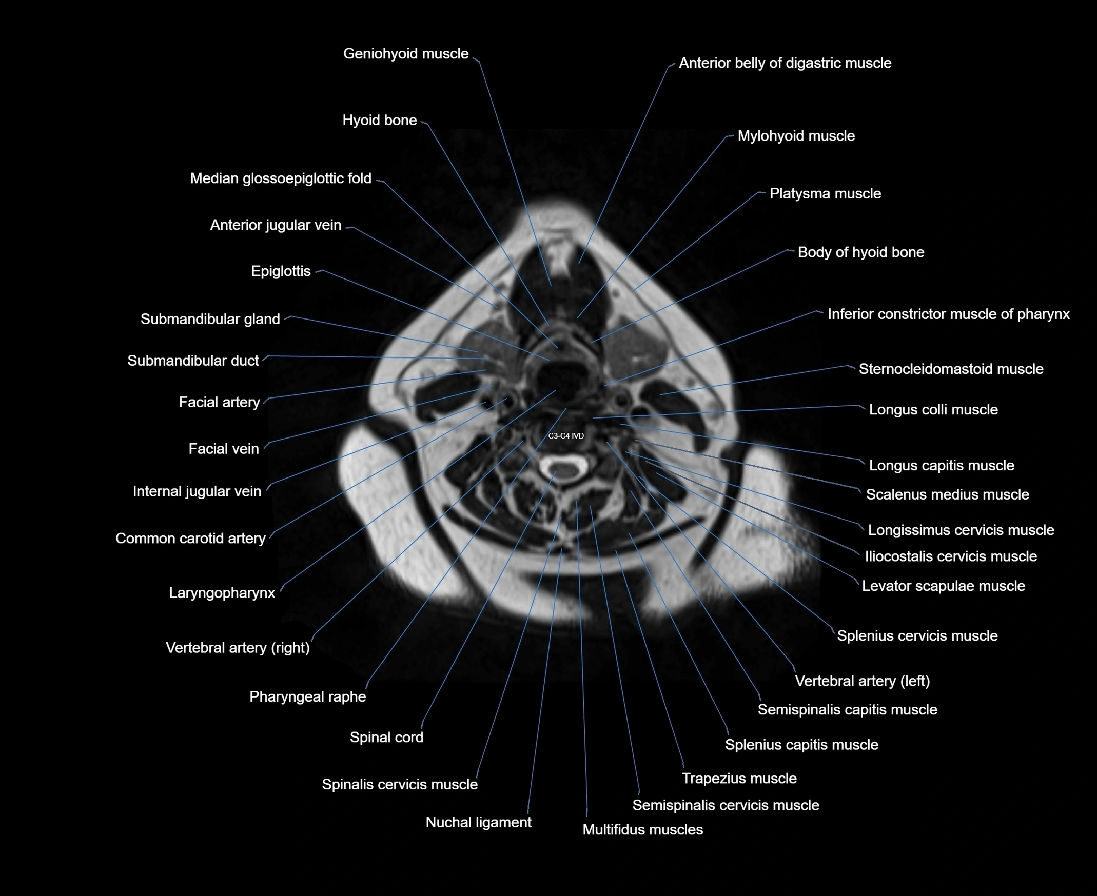MRI Neck 3D labelled cross section anatomy axial 3t image-00001-00050.webp